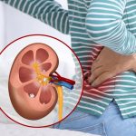 Komplikasi Batu Saluran Kemih yang Menyebabkan Gagal Ginjal dan Hemodialisis