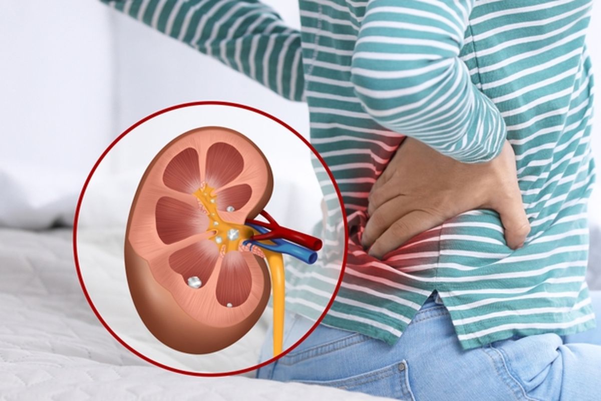 Komplikasi Batu Saluran Kemih yang Menyebabkan Gagal Ginjal dan Hemodialisis