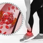 Penyakit Vaskular Perifer