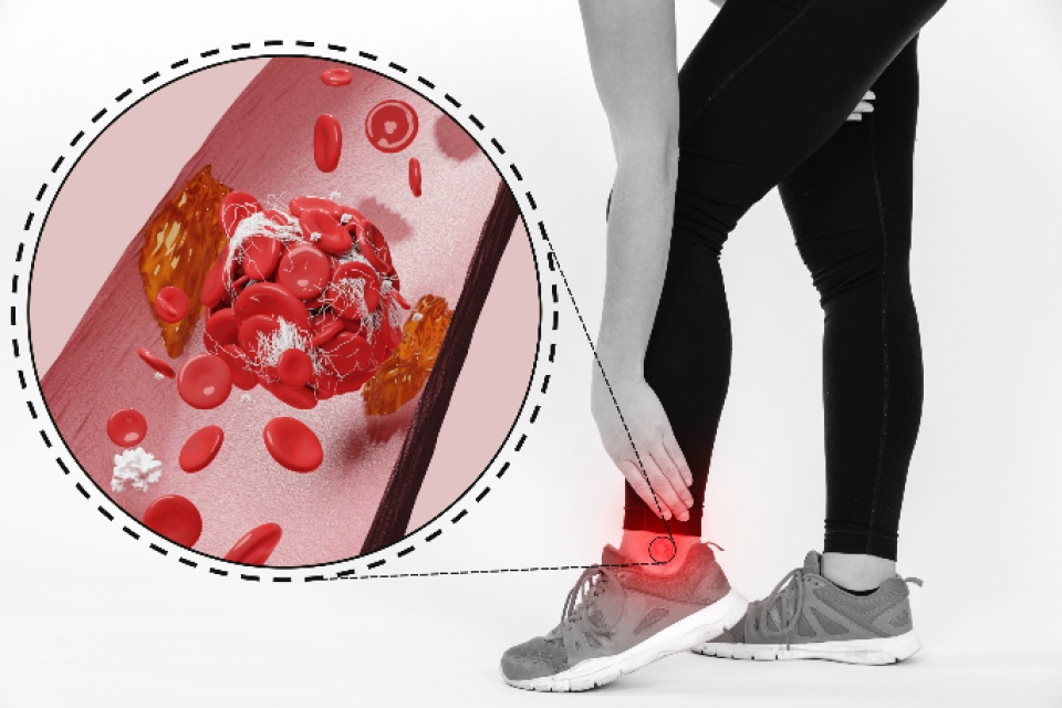 Penyakit Vaskular Perifer